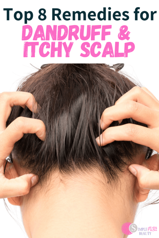 Top 8 Natural Home Remedies for Dandruff and Itchy Scalp Simple Pure