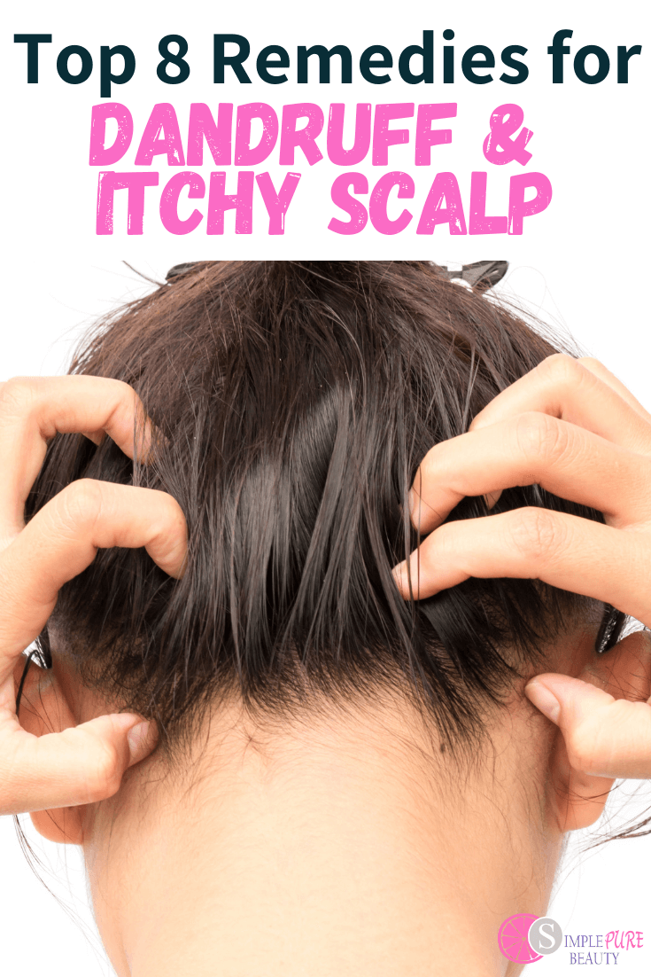Natural home remedies for dandruff and itchy scalp