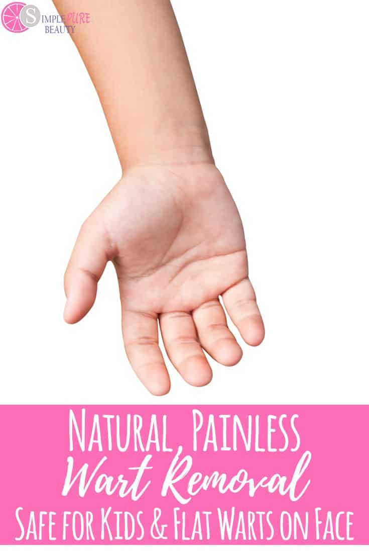 After trying all of the conventional wart removal remedies, we finally found this natural, painless wart removal for kids. It worked on regular warts, flat warts, and even plantar warts! #wartremoval #natural