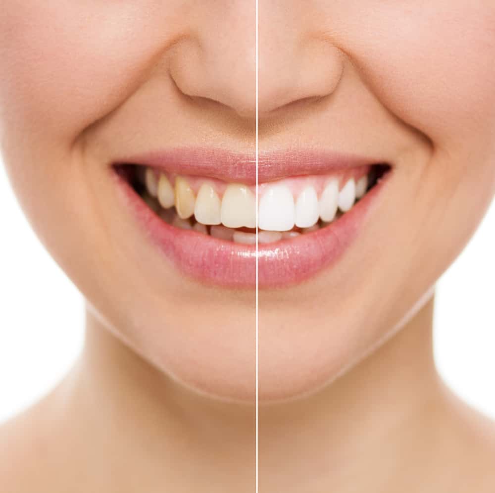 Want pearly white teeth? Step away from the chemical-ridden store-bought teeth whitening kits and try one of these easy, at-home natural DIY teeth whitening recipes - for sparkling, white teeth without the harsh ingredients!